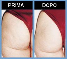 Lipomassage Endermologie LPG Milano